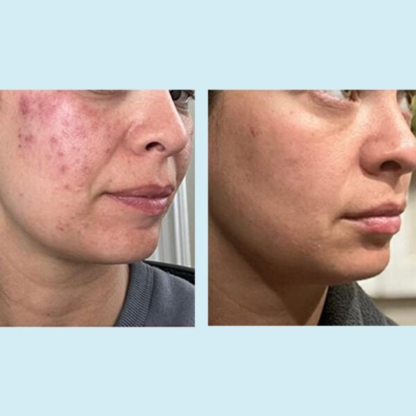 Glycolic Acid 50% Gel Peel - Image 3