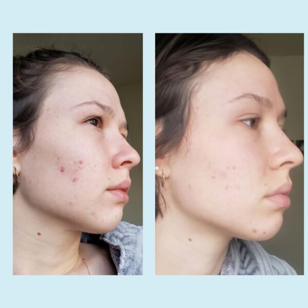 Glycolic Acid 50% Gel Peel - Image 4