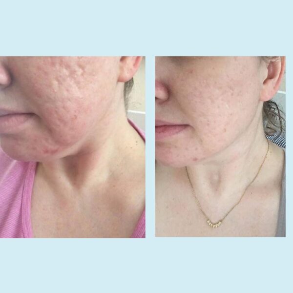 Glycolic Acid 50% Gel Peel - Image 5